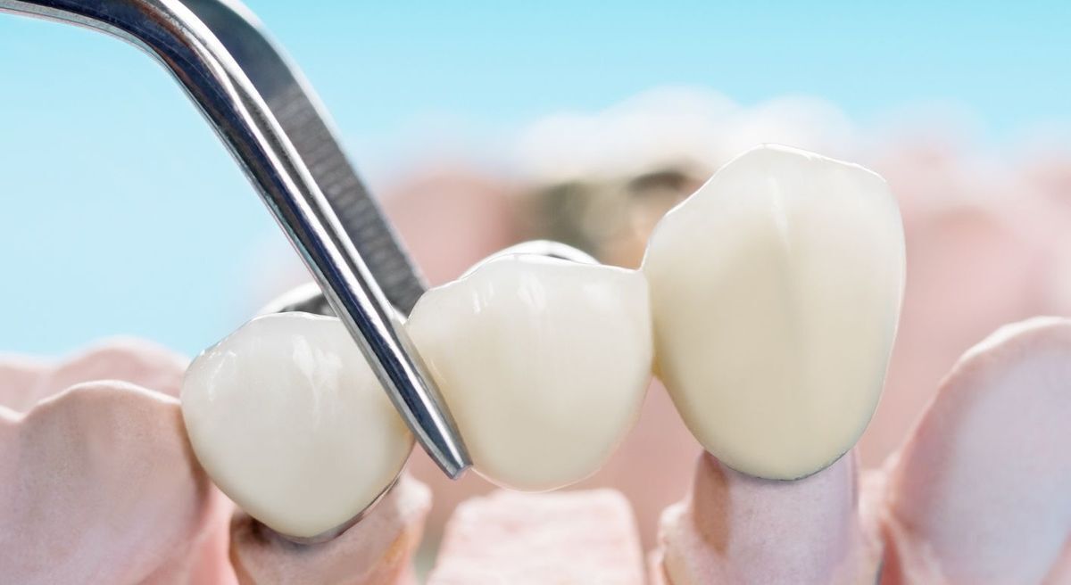 CES d'odontologie prothétique mention prothèse conjointe