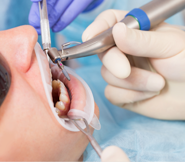 DU fondamental en implantologie